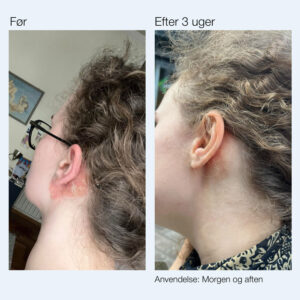 psoriasis gel foer efter